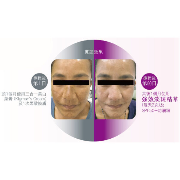 Cebelia 【強效淡斑精華】 Reinforced Depigmenting 激光煥白精華